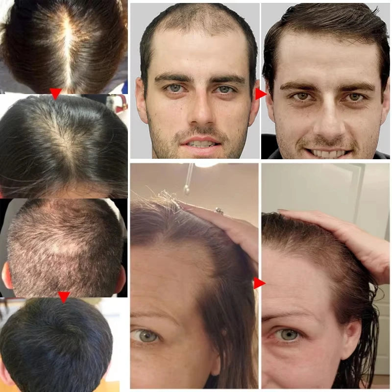 GroMax™ Fast Hair Growth Serum Spray – Anti-Hair Loss & Root Repair Treatment for Men & Women